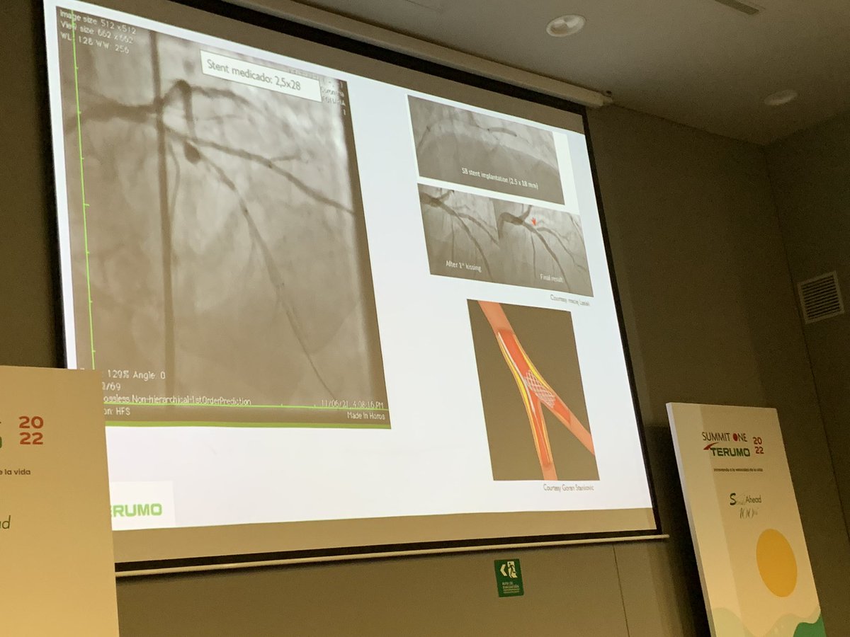 Mamas A. Mamas (@mmamas1973) on Twitter photo Great talk about DK crush with steps by <a href="/IvanRendonm/">ivan rendon</a> , #imagefirst #radialfirst . Important to follow steps with FKB/ POT with adequately sized balloon for crush <a href="/HanCardiomd/">Henry Han</a> <a href="/GoranEBC/">Goran Stankovic, MD, PhD</a> <a href="/mirvatalasnag/">MIЯVΛƬ #IC</a> <a href="/cardioPCImom/">Ki Park</a> <a href="/Hragy/">Hany Ragy</a> Great talk about DK crush with steps by <a href="/IvanRendonm/">ivan rendon</a> , #imagefirst #radialfirst . Important to follow steps with FKB/ POT with adequately sized balloon for crush <a href="/HanCardiomd/">Henry Han</a> <a href="/GoranEBC/">Goran Stankovic, MD, PhD</a> <a href="/mirvatalasnag/">MIЯVΛƬ #IC</a> <a href="/cardioPCImom/">Ki Park</a> <a href="/Hragy/">Hany Ragy</a>