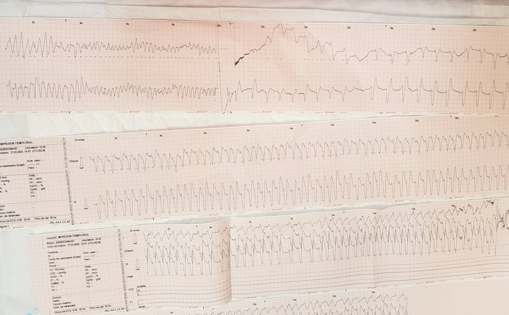 socramlavia's tweet photo. Cuando el ♥️ se pone rebelde en la 🚑.
♂️ 69 FV ⚡/ TVSP ⚡/ tormenta arrĺtmica / IAM anterior (tronco común). Tratamiento ya en 🏥 cateterismo más soporte ECMO AV.
@semgencat @GrupPau  @galicia_061 @soctescat @eus_tes #N602 https://t.co/zsKCfuiY3D