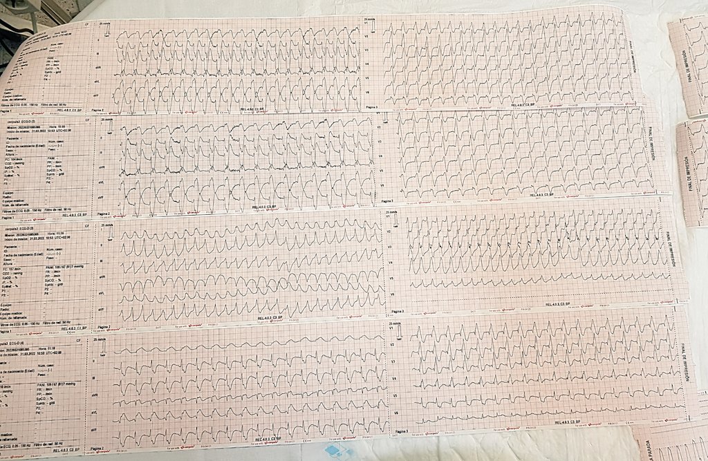 socramlavia's tweet photo. Cuando el ♥️ se pone rebelde en la 🚑.
♂️ 69 FV ⚡/ TVSP ⚡/ tormenta arrĺtmica / IAM anterior (tronco común). Tratamiento ya en 🏥 cateterismo más soporte ECMO AV.
@semgencat @GrupPau  @galicia_061 @soctescat @eus_tes #N602 https://t.co/zsKCfuiY3D