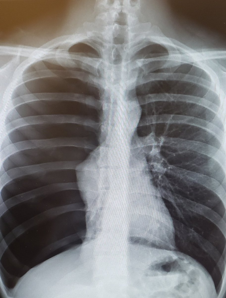 Had a patient in the ED today presenting with chest pain and SOB. CXR showed a large pneumothorax with complete collapse of the lung requiring a chest tube. Only significant history was vaping. I know there's been cases but it was kinda wild to see in person.