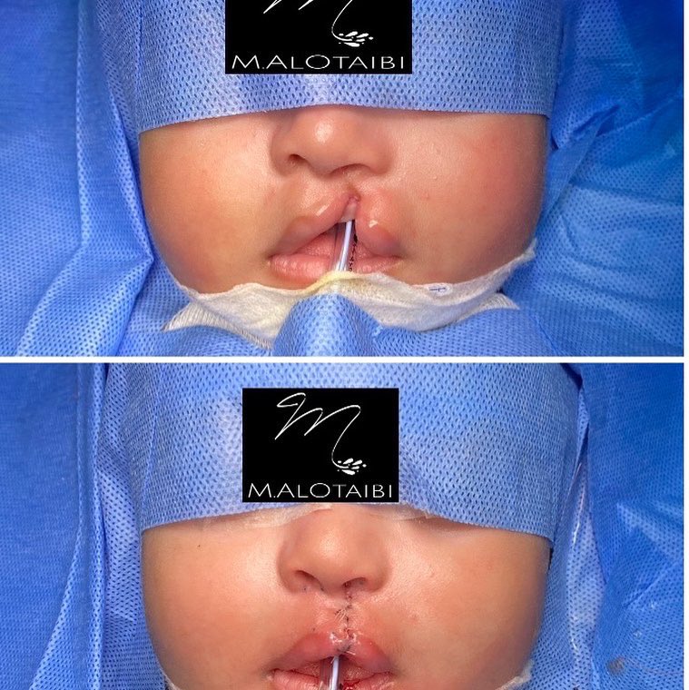 mh_omfs's tweet photo. حالة تصحيح جراحي للشفة الأرنيبية
#omfs
#plasticsurgery 
#جراح_تجميل https://t.co/CEg0fj8llD
