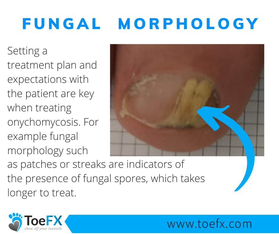 toe_fx's tweet photo. Setting a treatment plan and expectations with the patient are key when treating onychomycosis. Understand how in this week's earlier episode of Toenail Fungus Tuesday. https://t.co/jixWOGRZmQ
 #ToeFX #toenailfungus #onychomycosis https://t.co/KIQVag1bHu