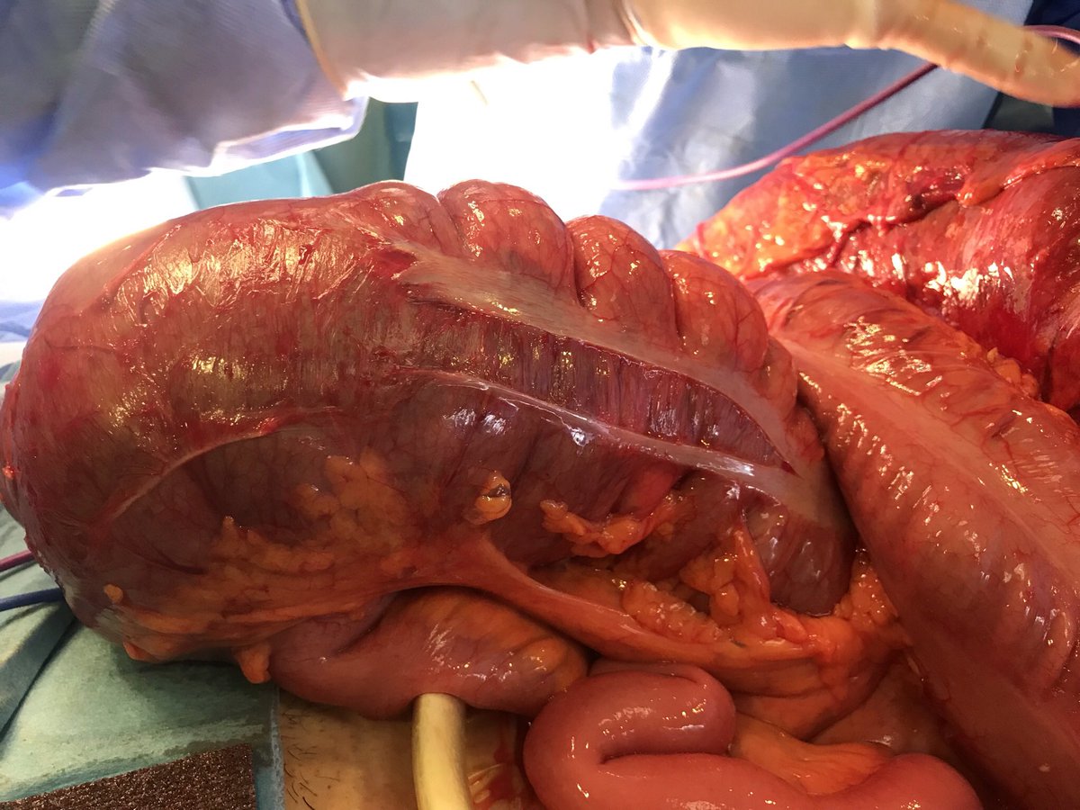 FelipePareja67's tweet photo. Hoy día mundial del Cáncer de Colon. En 2021 operamos de urgencia en @CirugiaHUVR 75 pac. Son solo una pequeña parte del total ⏩se puede prevenir ⏩cribado>50⏩colonoscopia pac de riesgo. ⏩Resultados en urgencia peor que reglado https://t.co/uQQCfDRYnY