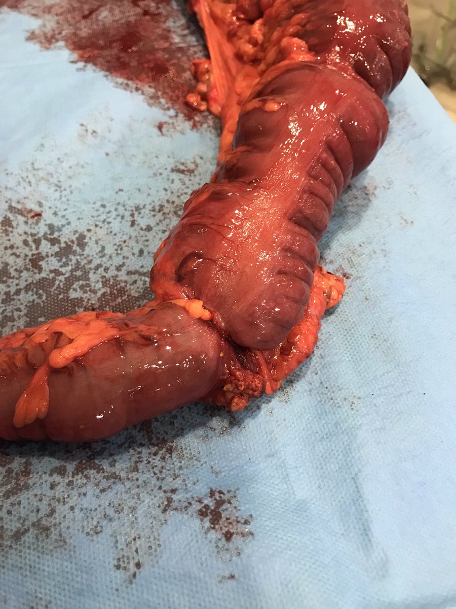 FelipePareja67's tweet photo. Hoy día mundial del Cáncer de Colon. En 2021 operamos de urgencia en @CirugiaHUVR 75 pac. Son solo una pequeña parte del total ⏩se puede prevenir ⏩cribado>50⏩colonoscopia pac de riesgo. ⏩Resultados en urgencia peor que reglado https://t.co/uQQCfDRYnY