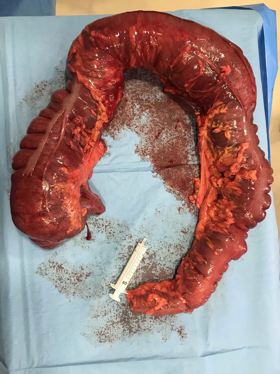 FelipePareja67's tweet photo. Hoy día mundial del Cáncer de Colon. En 2021 operamos de urgencia en @CirugiaHUVR 75 pac. Son solo una pequeña parte del total ⏩se puede prevenir ⏩cribado>50⏩colonoscopia pac de riesgo. ⏩Resultados en urgencia peor que reglado https://t.co/uQQCfDRYnY