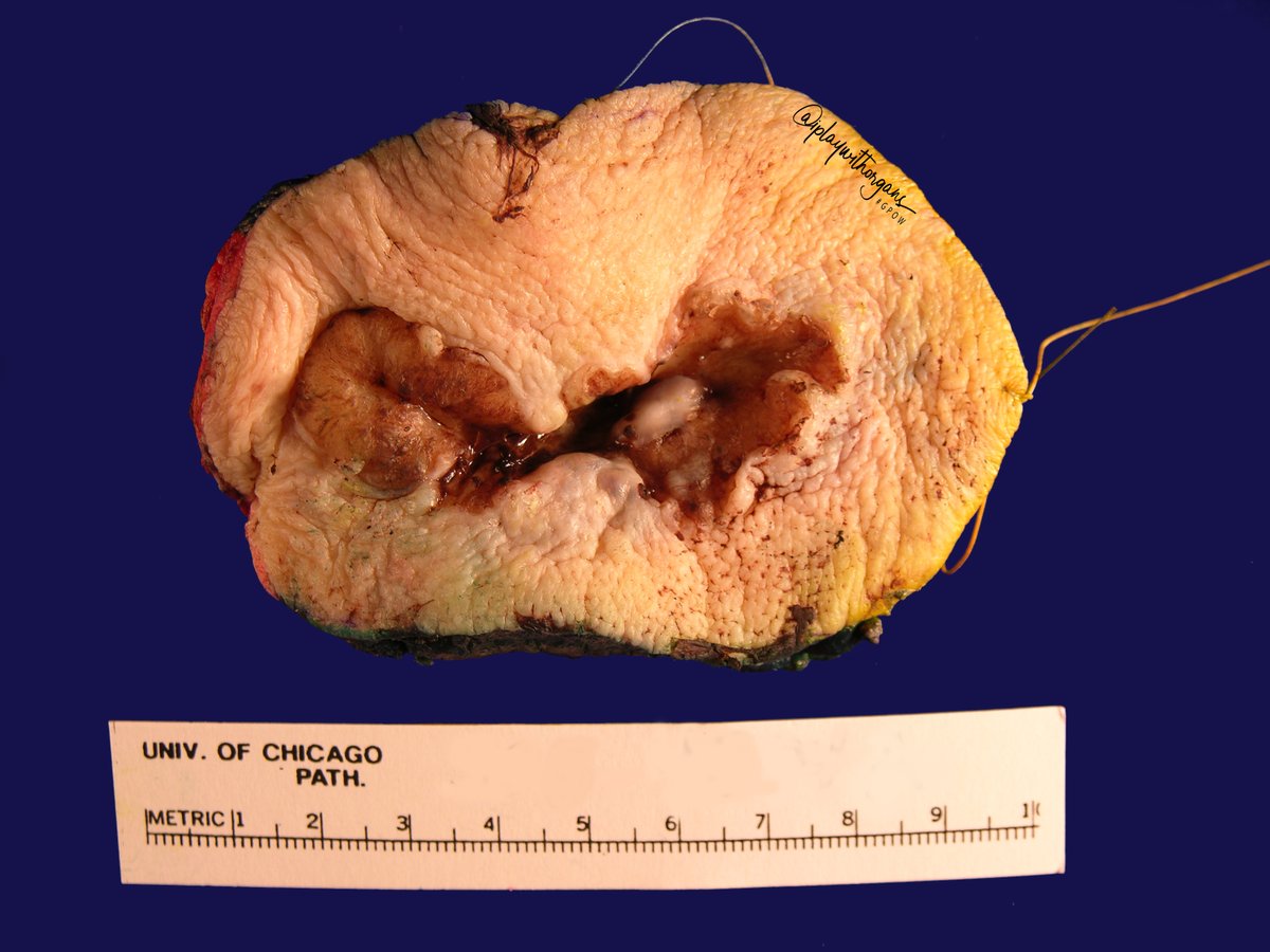 iplaywithorgans's tweet photo. Basosquamous carcinoma

💡a.k.a. metatypical BCC
👻Fair skinned people
👨>👩
👴6th to 8th decade
📍Most common on head and neck
🔪Firm, ulcerative, homogenous gray cut surface
🔬💜BCC w/ foci of squamous differentiation
🔬💙Ber EP4 +, EMA and CAM 5.2 –

#GPOW #beardedPA #UofCPath https://t.co/ord4Y95JR0