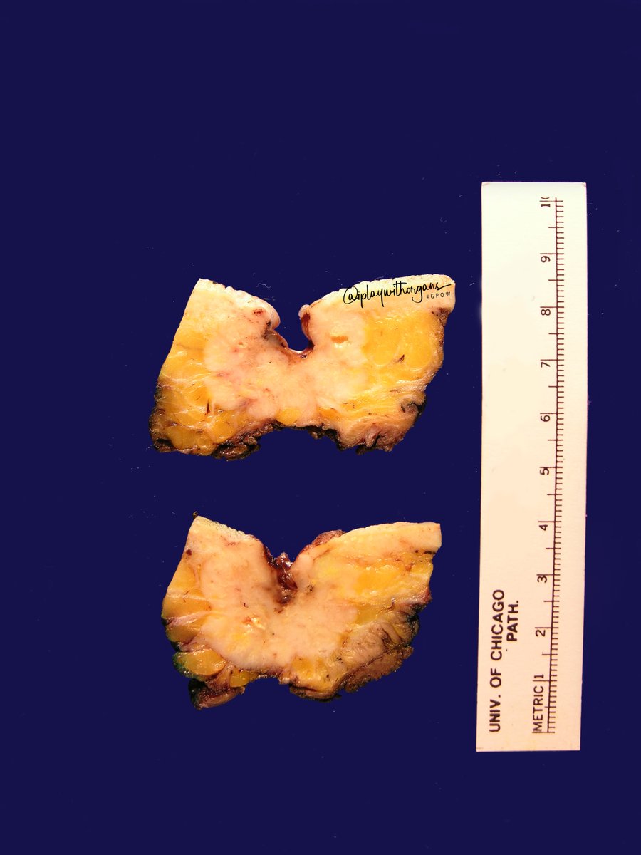 iplaywithorgans's tweet photo. Basosquamous carcinoma

💡a.k.a. metatypical BCC
👻Fair skinned people
👨>👩
👴6th to 8th decade
📍Most common on head and neck
🔪Firm, ulcerative, homogenous gray cut surface
🔬💜BCC w/ foci of squamous differentiation
🔬💙Ber EP4 +, EMA and CAM 5.2 –

#GPOW #beardedPA #UofCPath https://t.co/ord4Y95JR0
