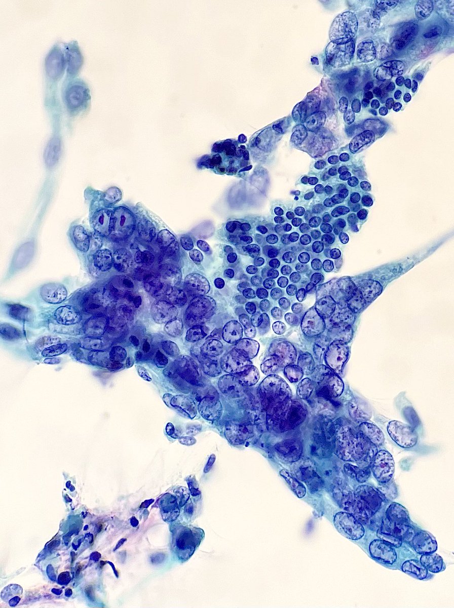 Endoscopic fine needle aspiration of a mass in the head of the pancreas. Ductal adenocarcinoma cells are seen adjacent to a sheet of benign ductal cells. #PathArt #PathTwitter #Cytopath #Pathology