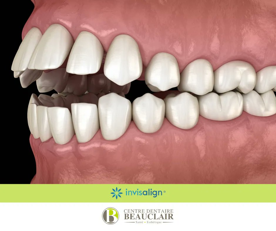 DreBeauclair's tweet photo. Si vos dents supérieures et inférieures ne se touchent pas lorsque votre bouche est fermée, il s’agit d’une béance. Traditionnellement, cette condition est traitée avec des broches en métal. Cependant, Invisalign offre une option de traitement plus confortable et moins invasive ! https://t.co/8DhkpQ8jbV
