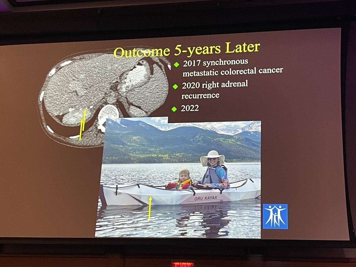 Thuy Tran, MD (@thuytranmd) on Twitter photo Wonderful keynote talk by <a href="/SoCalYuman/">Yuman Fong</a> on colorectal liver mets resection. Goals of resection: more cure, less invasive, available for all. Also, <a href="/SoCalYuman/">Yuman Fong</a> is the best mentor and sponsor I know. <a href="/CamilleLStewart/">Camille Stewart, MD</a> <a href="/LThornblade/">Lucas W. Thornblade, MD MPH</a> <a href="/laleh_melstrom/">Laleh Melstrom</a> <a href="/GKMalhotraMD/">Gautam Malhotra, MD PhD</a> Wonderful keynote talk by <a href="/SoCalYuman/">Yuman Fong</a> on colorectal liver mets resection. Goals of resection: more cure, less invasive, available for all. Also, <a href="/SoCalYuman/">Yuman Fong</a> is the best mentor and sponsor I know. <a href="/CamilleLStewart/">Camille Stewart, MD</a> <a href="/LThornblade/">Lucas W. Thornblade, MD MPH</a> <a href="/laleh_melstrom/">Laleh Melstrom</a> <a href="/GKMalhotraMD/">Gautam Malhotra, MD PhD</a>