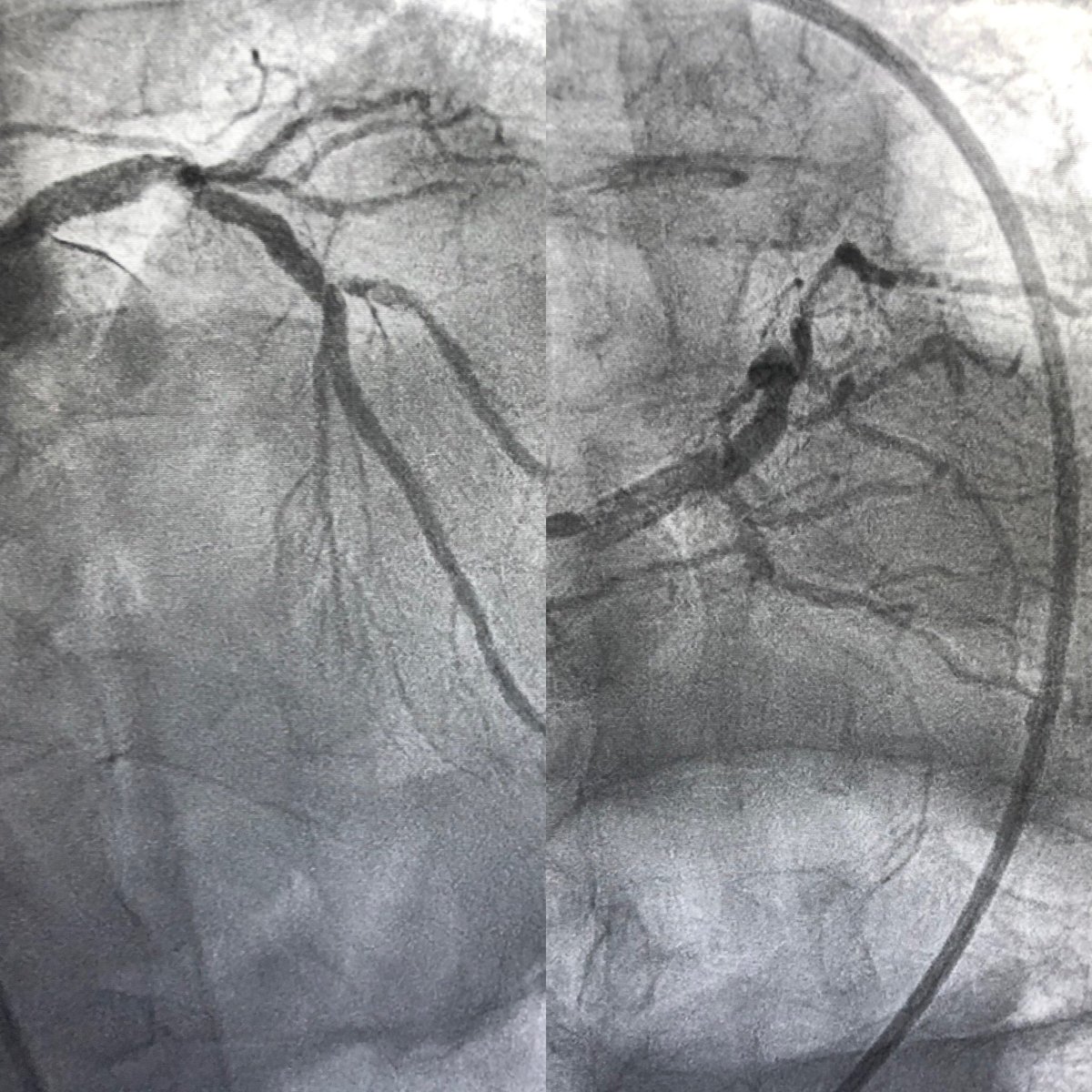 EthelbertH1's tweet photo. Inferior STEMI and LM/Multi vessel Coronary disease. Staged PCI. #RadialLoop #ScheperdsCrook Right Coronary Artery #ComplexCoronaryCases #InterventionalCardiology @RadialFirstBot https://t.co/uVgCgFQxPo