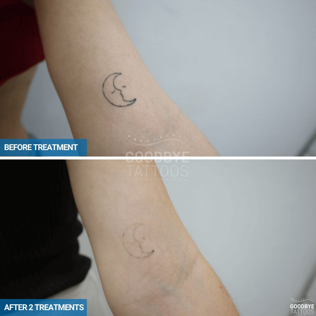 Laser Tattoo Removal  US Dermatology Partners