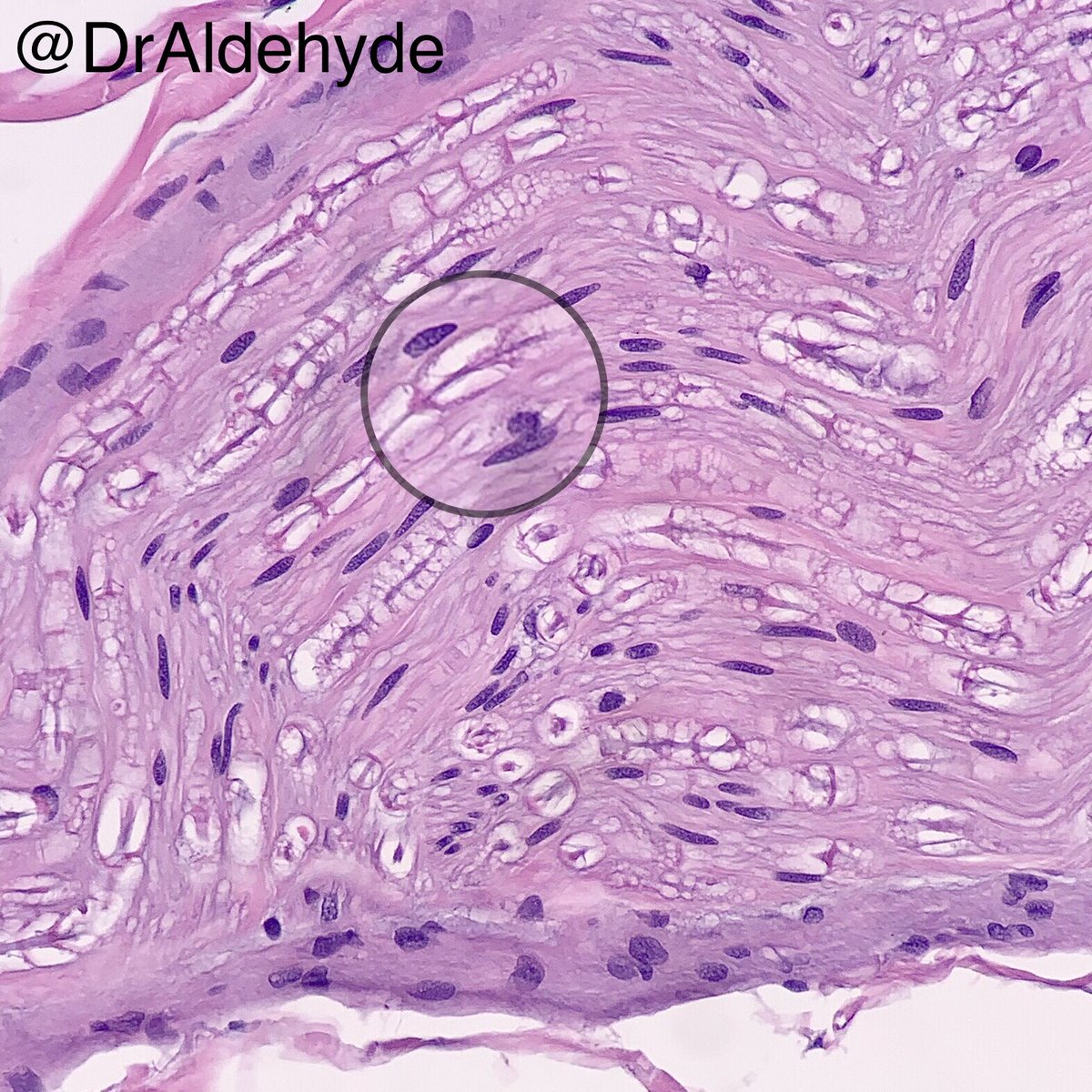 DrAldehyde's tweet photo. Non-stop sentinel LN rampage special. 😆🔬
After screening over 30 contiguous lymph nodes for a single melanoma cell (+ a bunch of capsular nevi as bonus) met, at least I got to see this morphologic beauty at the end just outside the LNs.
Schmidt-Lanterman incisures
#dermpath https://t.co/Ovg7HrCx9E