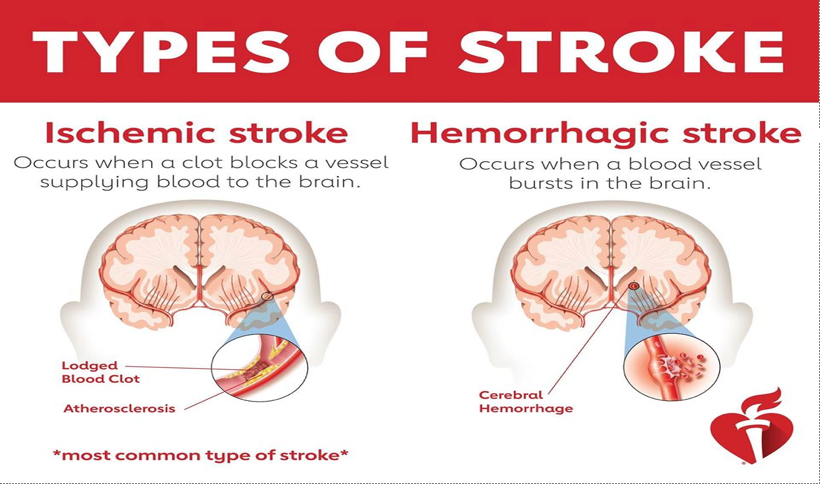 MedTweetMYHQ's tweet photo. Malam ini kita akan live untuk menjawab soalan tentang stroke & brain injury bersama dengan saya, @wahidatul_abdah di #MTMspaces
Hari ini mari kita senaraikan mitos-mitos yang pernah kita dengar tentang stroke.
#MedTweetMY
#strokerehab
#OccupationalTherapy https://t.co/FpglCjha30