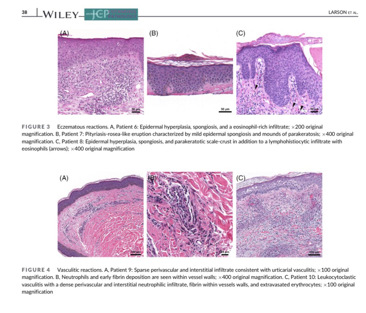 We are currently discussing the spectrum of eczematous, vasculitic, drug eruption and immunobullous reactions following #COVID19 vaccination. #dermpathJC #dermpath #dermtwitter. Open access paper at link: onlinelibrary.wiley.com/doi/epdf/10.11…