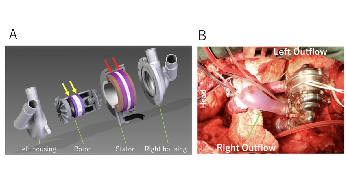 ArtifOrgans's tweet image. #Pulsatility #Hemodynamics during Speed Modulation of #ContinuousFlow Total #ArtificialHeart in a Chronic #InVivo
#OnlineFirst👉bit.ly/3iWwcmV
@ClevelandClinic @CCLRI @miyamotocs @C_Miyagi_MD @KiyoFukamachiMD