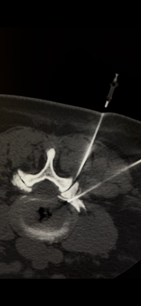 Diogo Edelmuth (@dgleao) on Twitter photo Many out there use biopsy grids?
Not sure worth spending too much money on them, but been using these in-house 3D-printed models by <a href="/carlosflobo/">carlosfelipelobo</a> and they sure add some ease and precision to the planning phase
#radres #radtwitter #mskrad #irad Many out there use biopsy grids?
Not sure worth spending too much money on them, but been using these in-house 3D-printed models by <a href="/carlosflobo/">carlosfelipelobo</a> and they sure add some ease and precision to the planning phase
#radres #radtwitter #mskrad #irad