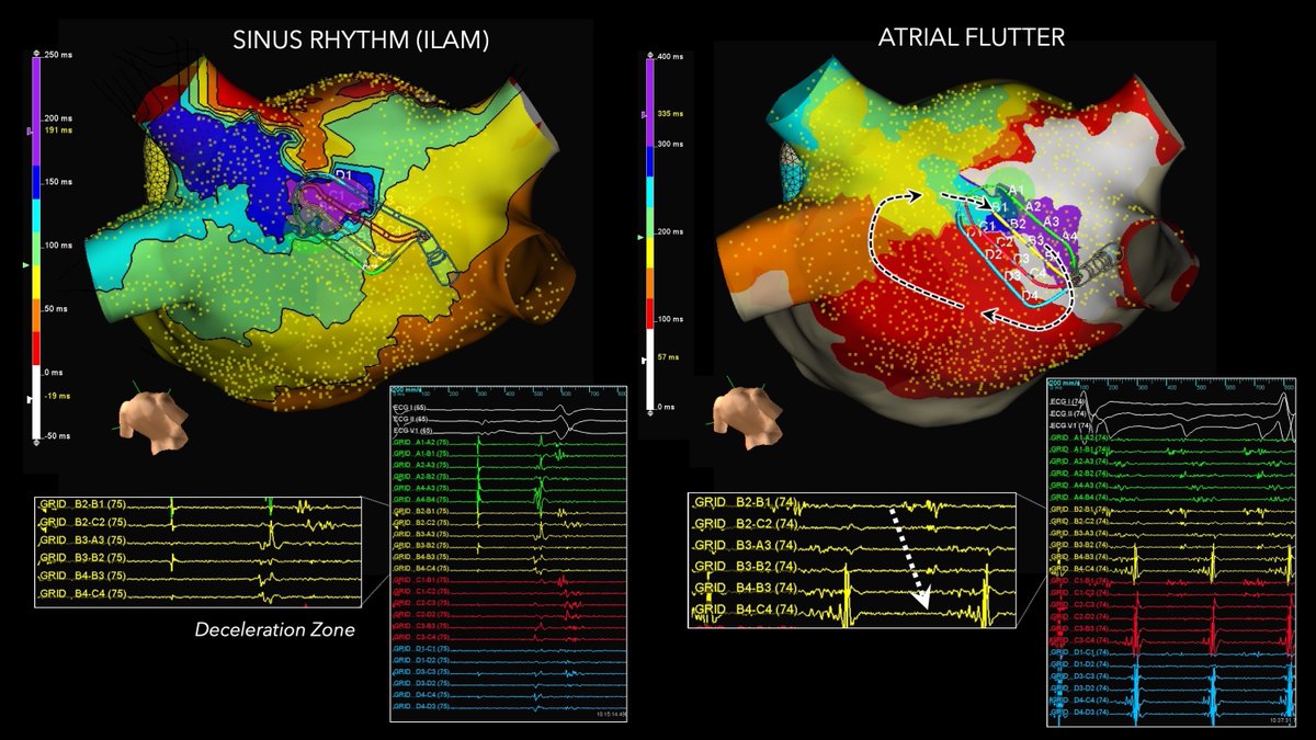 ILAM for localized LA flutter?! Congrats to @EPWoodsShop for leading 🙏. DZ can be overt niduses for reentry in the atrium. Perhaps a potential PVI+. #QSQ Correlation Between Sinus Rhythm Deceleration Zones and Critical Sites for Localized Reentry heartrhythmopen.com/article/S2666-…