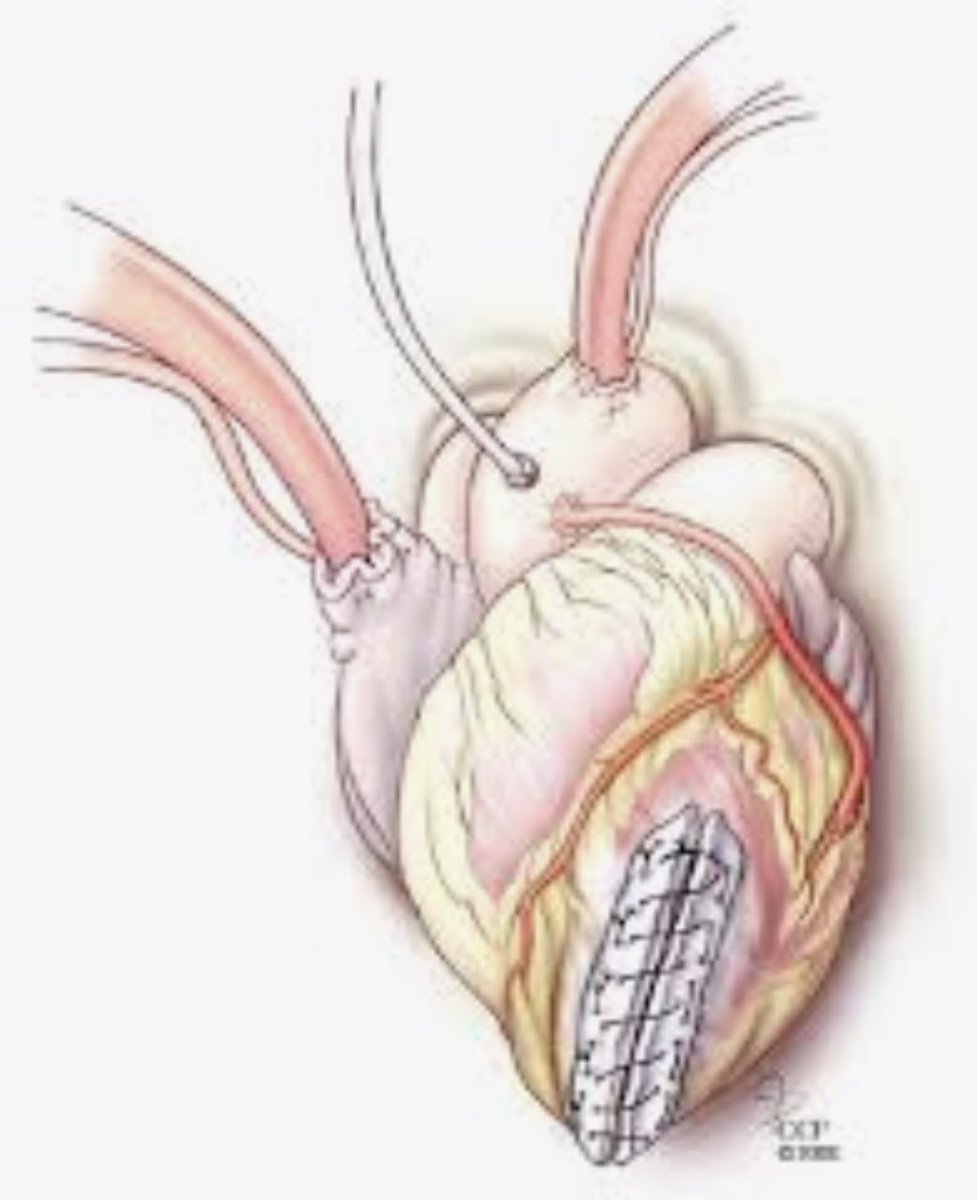 ChaseSurgical's tweet photo. Vincent Dor is a French Cardiothoracic surgeon who developed the Dor Procedure. This is viable method for restoring a dilated left ventricle to its normal, elliptical geometry. The Dor procedure uses a circular suture and a Dacron patch to correct LV aneurysms. @ctsnetorg #CTSnet https://t.co/v2gW3xCKg2