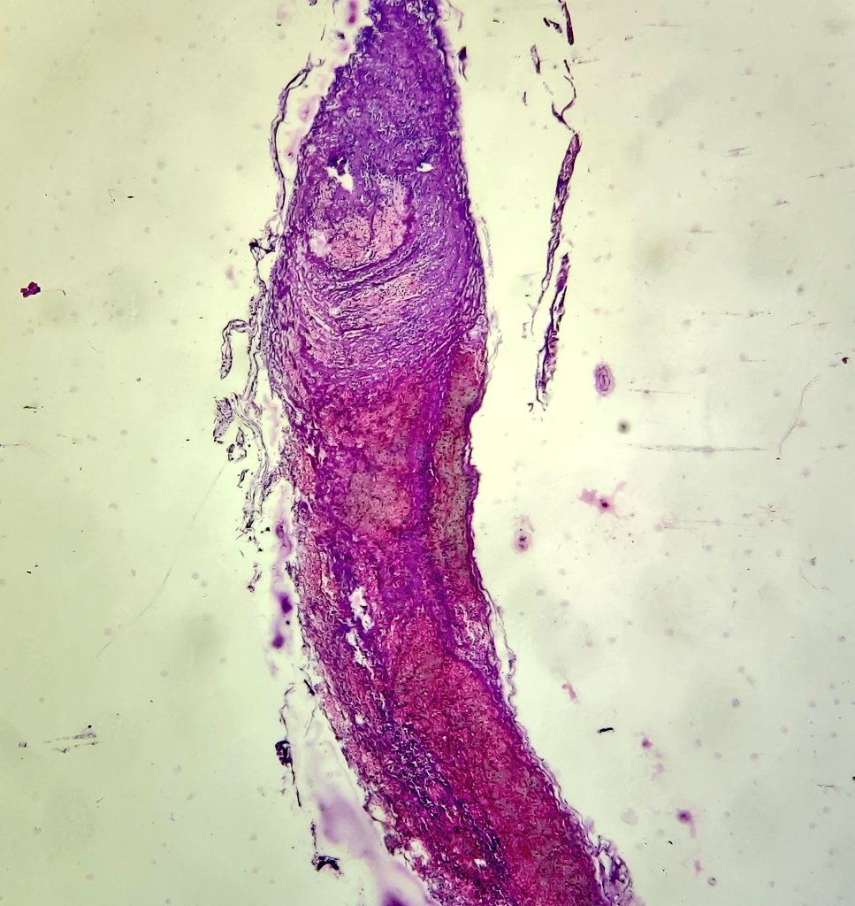 niyatis25's tweet photo. Septic thrombus. #AutopsyPathology https://t.co/8pIGbyJMNT