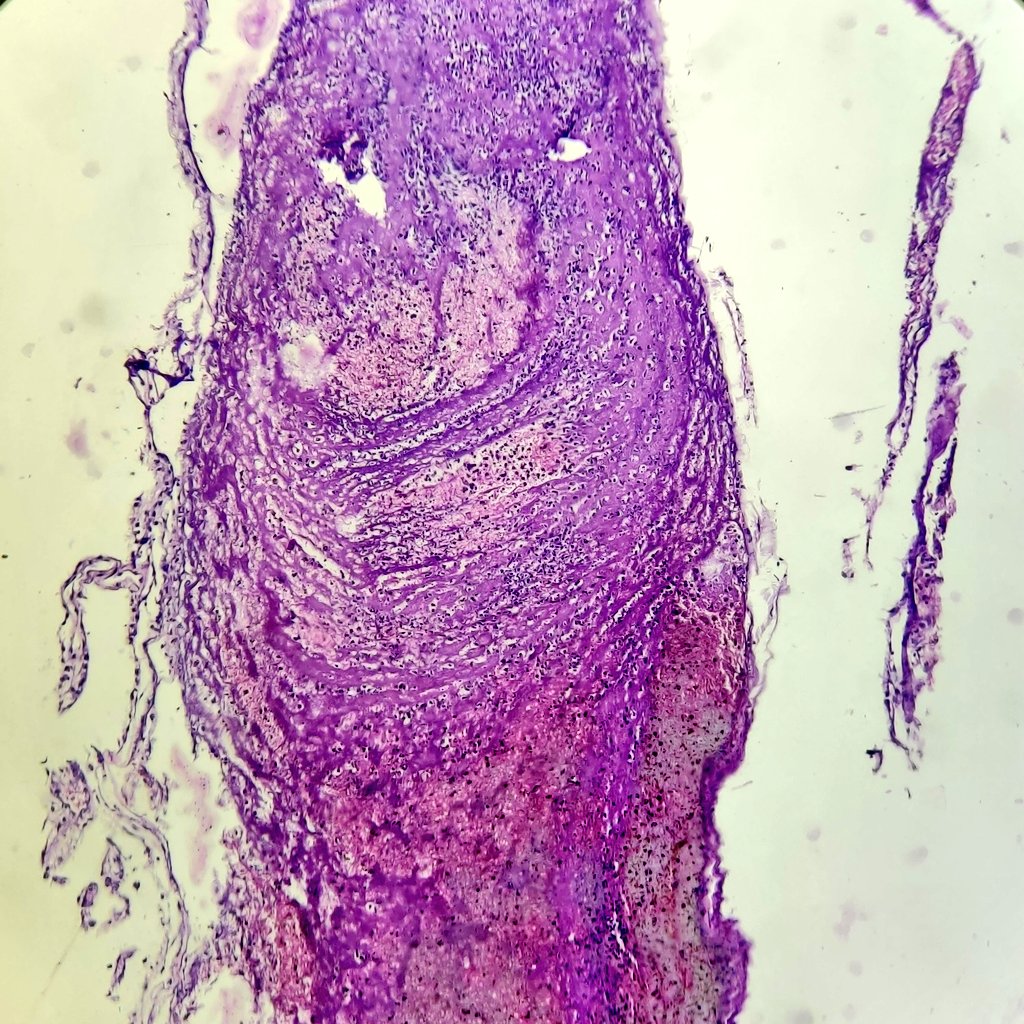 niyatis25's tweet photo. Septic thrombus. #AutopsyPathology https://t.co/8pIGbyJMNT