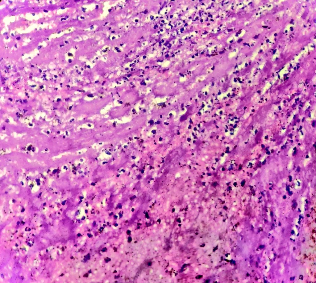 niyatis25's tweet photo. Septic thrombus. #AutopsyPathology https://t.co/8pIGbyJMNT