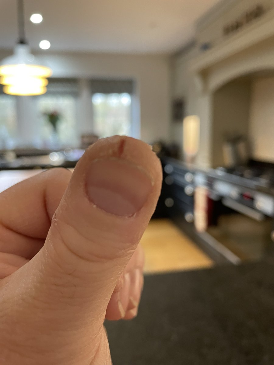 GriffoMedia's tweet photo. Who gets these tiny little finger cuts and why do they hurt so much?!👇😳 #fingercuts #throbbing https://t.co/EBJh4TWC6h