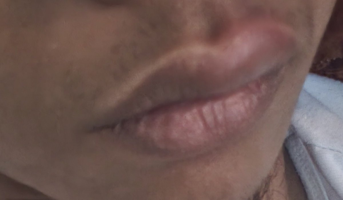 onotrakVD's tweet photo. @dawgie0360 @KemenkesRI Masih belum sampai sekarang, di bibir juga di mata juga, pokoknya di seluruh tubuh https://t.co/0a8hA8JFWJ