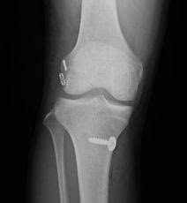 yuichi_hoshino's tweet photo. @NuelleSportsMD Yes, anatomic tunnel placement provides better rotational stability in addition to solid anterior stability.
Definitely not vertical.
e.g. anatomic double bundle using outside-in technique.
#anatomicACLreconstruction
#doublebundle
#rotatorykneelaxity https://t.co/pTFHmFM4Ql