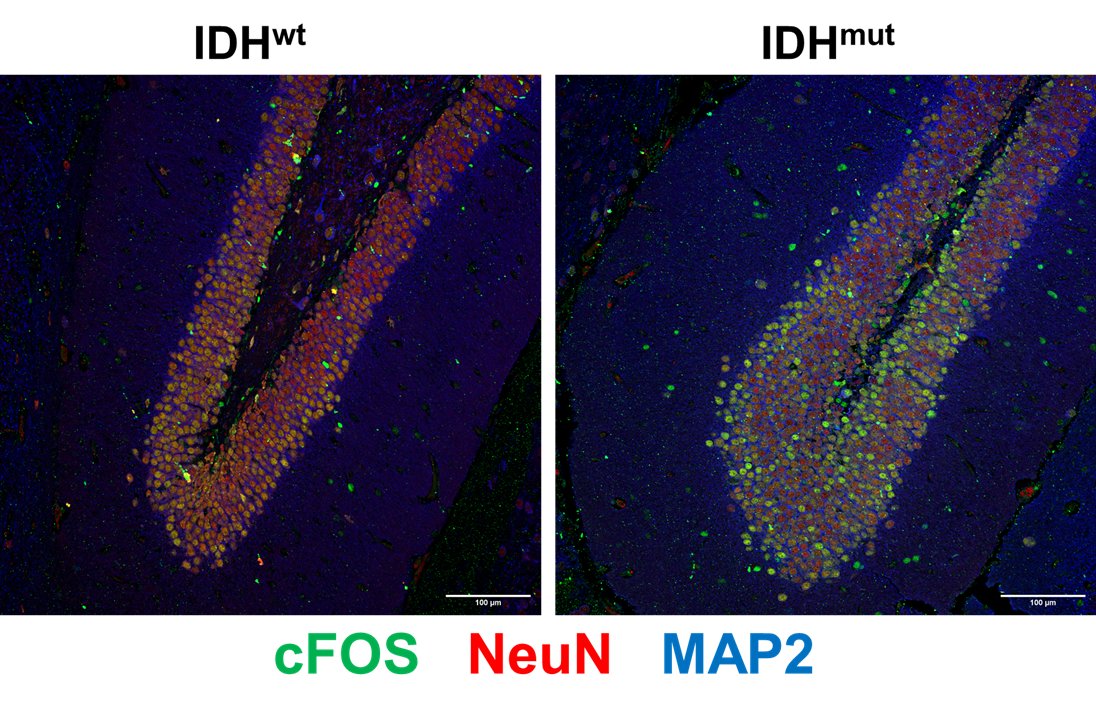 Hippocampal dentate gyri from mice engrafted with IDH wild-type versus IDH mutant glioma. You can't see the tumors here, because they're nowhere near the hippocampi. Yet look at how strong the neuronal excitation marker cFOS is in the IDHmut brain.