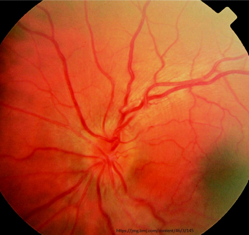 PANIRD_group's tweet photo. On Monday, we will have an interesting lecture from Dr. Carlos Mendoza MD on mitochondrial optic neuropathies! 
Date/Time: April 4th, 7:00 p.m. 
Zoom Link: https://t.co/PLOWWHUKNL
Have a great Friday!
#ophthalmology #optometry https://t.co/5PEIOzMLCt