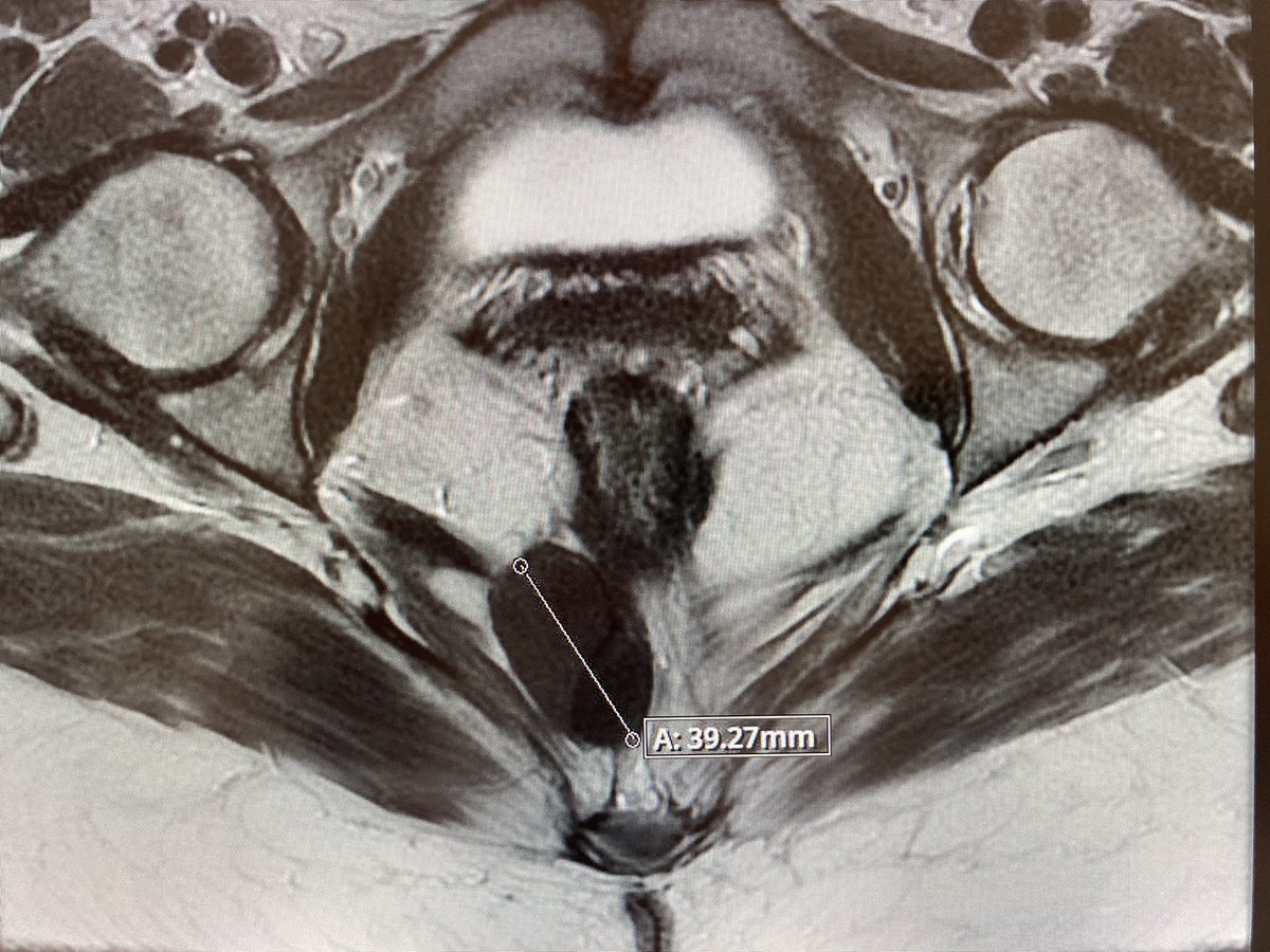 Incidental presacral cyst MRI. What would u do? Biopsy? Excision? Observation? RETWEET FOR MAXIMUM INPUT @SWexner @juliomayol @SAGES_Updates @wbpictures @AmCollSurgeons @ASCO @ASCOPost @YouESCP @escp_tweets @KarenZaghiyanMD @abbassmohd @EmreGorgun2 @DavidLiskaMD @FezaRemziMD