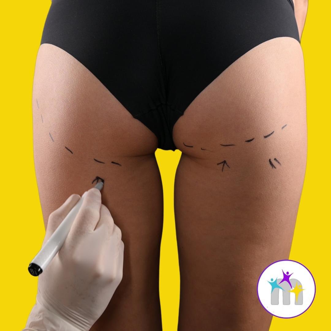 medicotrips's tweet photo. If you are self-conscious about your butt, the Brazilian butt lift procedure could be the best way for you to achieve the shape you desire 🍑
For more information, see: https://t.co/SifwtqB6My
#brazilianbuttlift #bumlift #buttlift #cosmeticsurgery #brazilianbumlift #bbl https://t.co/xmdd9Pt91s
