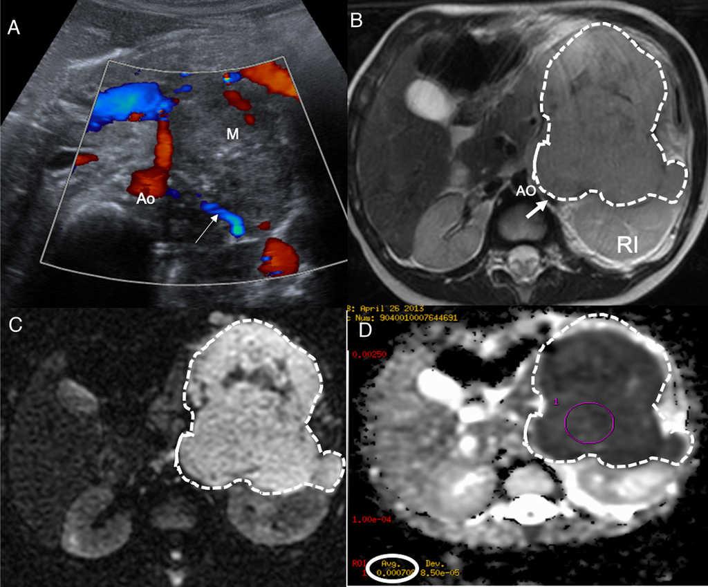 RevistaRADIOLO2's tweet photo. Informe estructurado en tumores abdominales pediátricos: neuroblastoma y nefroblastoma https://t.co/zp7cXsrT0h https://t.co/D5naEAATAg
