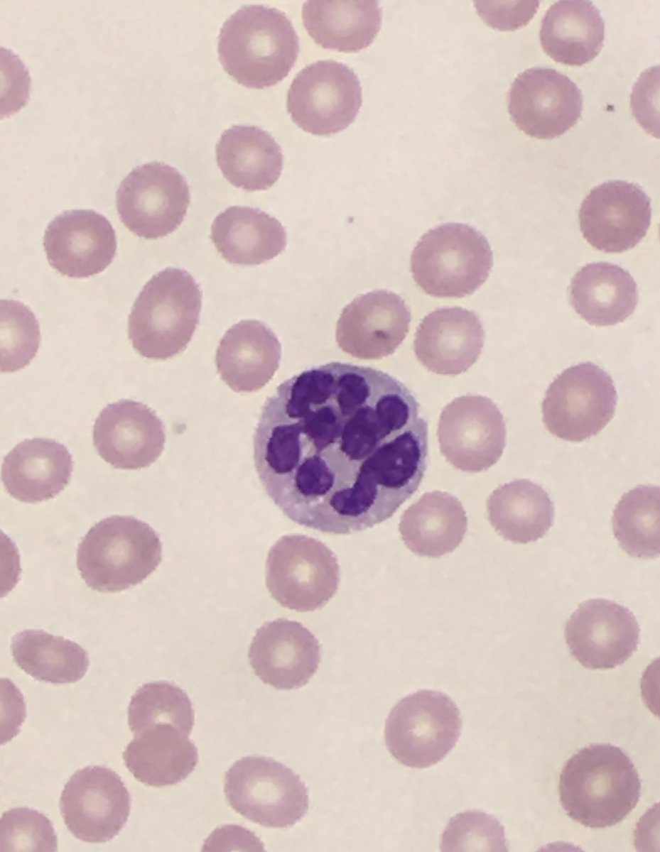 megothelioma's tweet photo. Hypersegmented neutrophil - associated with megaloblastic anemia (folate or vit B12 deficiency) #PathTwitter #blooducation #hemepath https://t.co/Cc7ZvpKZxf