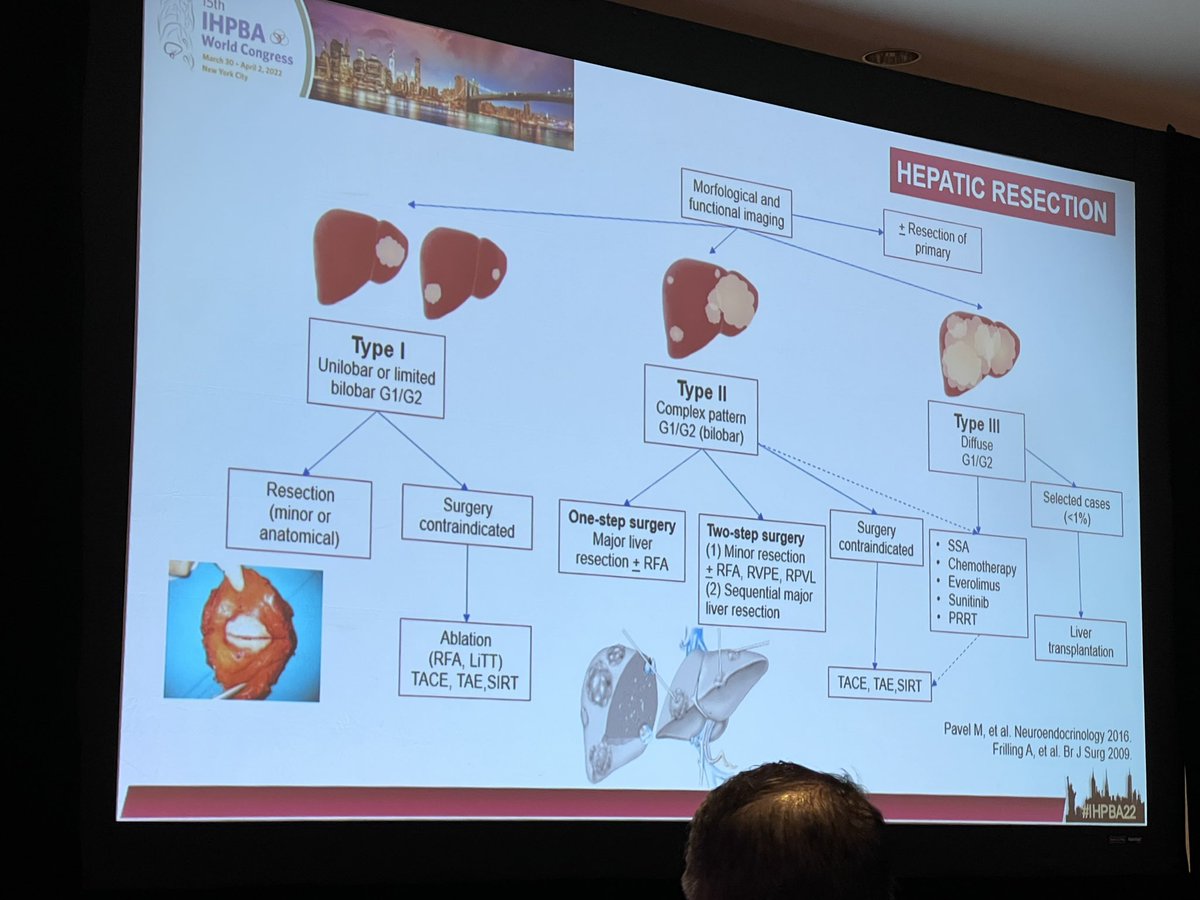nigeljamieson's tweet photo. Great #panets session @IHPBA navigating controversy/complexities
🔑
-Duct dilation<2cm tm suggests high risk dz
-individualised multi-modality (PRRT RFA) Strategy
-Rx sequencing
-parenchyma sparing for both prim/met
-neoadj the future?
-molecular staging
@CUpancreas @spartelli https://t.co/9rSniSDIss