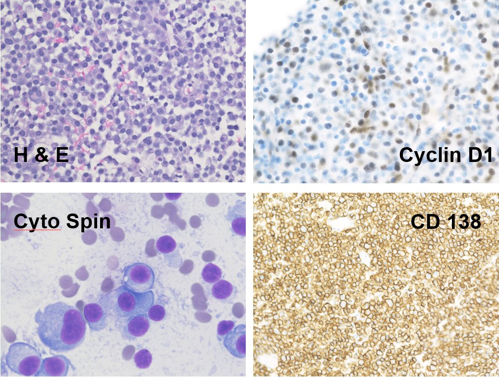 BGrant_MDJD's tweet photo. Hey, this is my first tweet on an interesting hematopathology case we have been working up. It was inspired by @KirillLyapichev . What is the diagnosis, prognosis, and translocation(s)? @UTMB_Pathology @PaulYoungMD1 @drfatimaiqbalk1 @JamieC_Kendrick @lgbigham92 #Hemepath https://t.co/TP4G3KlRuA