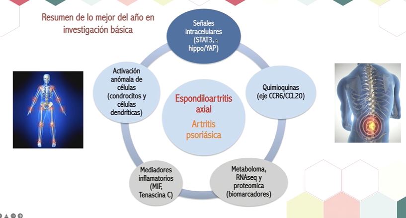 JOVREUM's tweet photo. Ojo👁️a las posibles nuevas dianas terapéuticas en EspAx y Apso #LOMEJORSPA22 
🔘Inh STAT3 ➡️ EspAx y APso
🔘Tenascina-C ➡️ EspAx 
🔘Proteína MIF ➡️EspAx
🔘CCR6/CCL20 ➡️Apso 
🔘Nuevo subtipo de cel dendríticas: CD209/CD14+ ➡️APso
🔘Activación aberrante de condrocitos➡️ EspAx https://t.co/bIObKaaKd9
