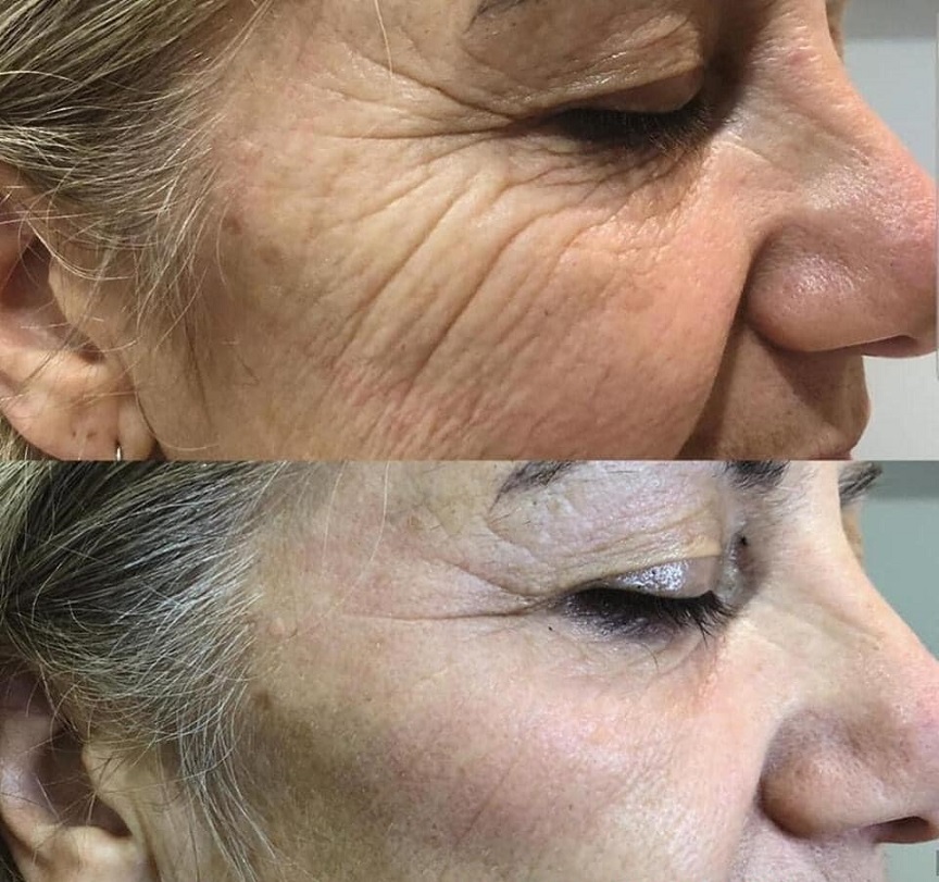 EVALASERTECH's tweet image. The voice from clients is the best compliment, thanks. 
Always be grateful, and work harder to offer more professional products and service. 
#hifu #hifu7D #facelifting #skintightening #ultrasound #bodyshaping #cellulitereduction #wrinkleremoval #necklineremoval #spaowner