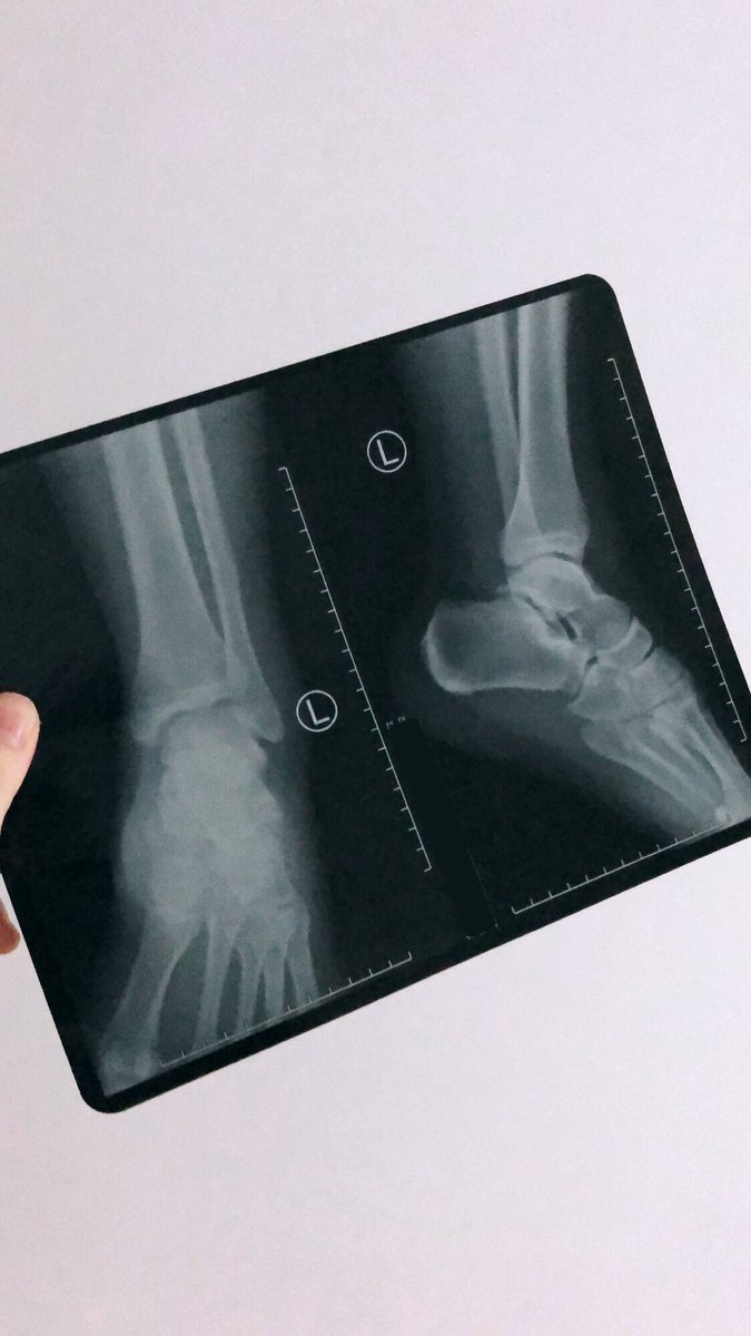 nickbogdan's tweet photo. At least the X-rays look good. 
I wish it was a joke though 🤦🏻‍♂️

PS I'll keep sketching even if I have to stay in bed haha

#nft #nfts #nftcommunity #wagmi #nftproject #pfp #pfpNFT #gm #nftcollection #nftcenter #eth #nftcommunity #designer #creator https://t.co/oZAoQ42KFQ