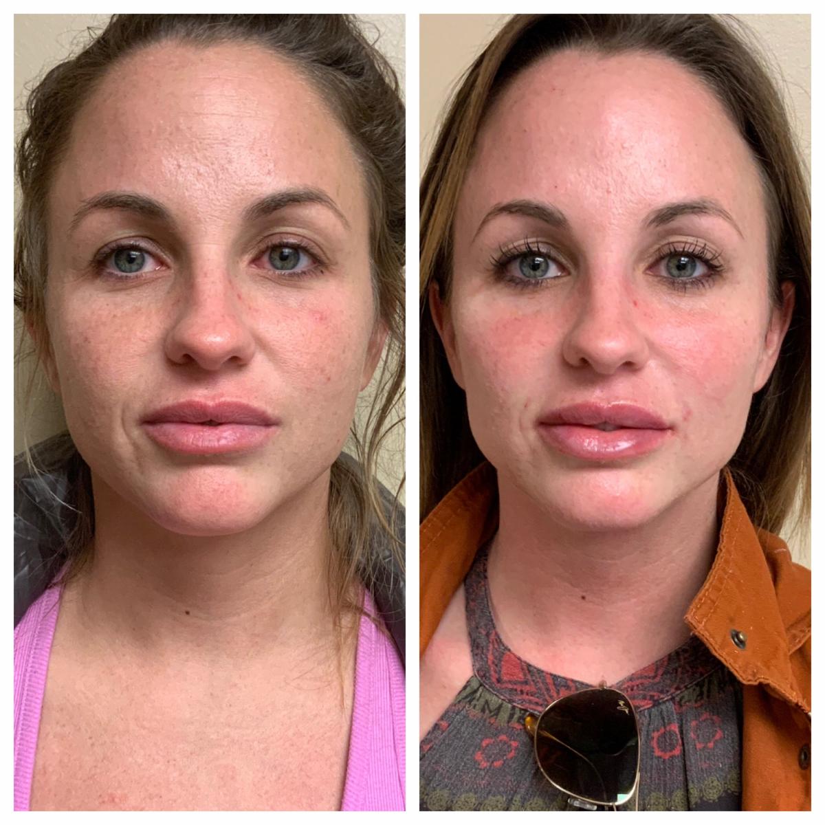 DrAdrianLo's tweet photo. Happy Friday! 🌷 We have a 33 year old patient here treated with BOTOX® 💉 to correct forehead wrinkles and lines around her eyes, as well as mid-face filler for cheek enhancement, nasolabial folds around the mouth, and a subtle lip enhancement 👄 for hydration! 🌟 #BotoxPhilly https://t.co/cWP0lCaLBo
