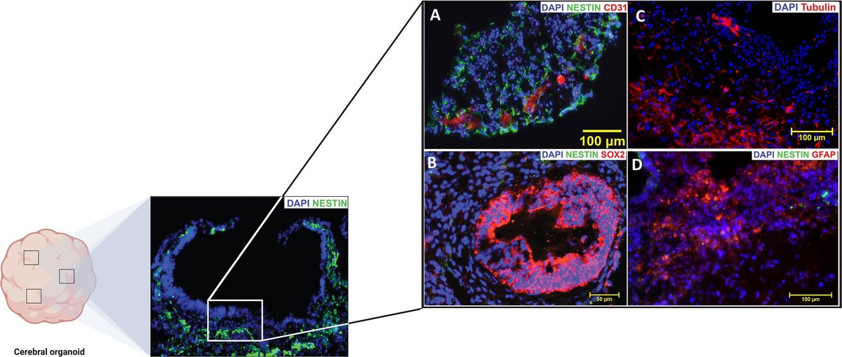 Check out our latest article @FrontOncology in which we comprehensively review the role of the subventricular zone in the genesis and maintenance of glioblastoma. @pascalzinn @NdukaAmankulor @PittNeurosurg