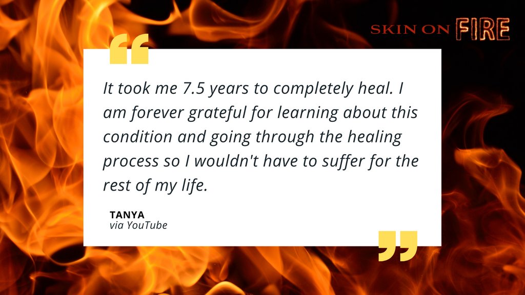 PCHFilms's tweet photo. SKIN ON FIRE is now streaming on YouTube.
Learn more about Topical Steroid Withdrawal (TSW) and how it may be treated -- and prevented.
Watch it now: https://t.co/mnysnm8dzw
#skinonfiredoc #tsw #topicalsteroidwithdrawal #topicalsteroidaddiction https://t.co/io5pvrIFbp