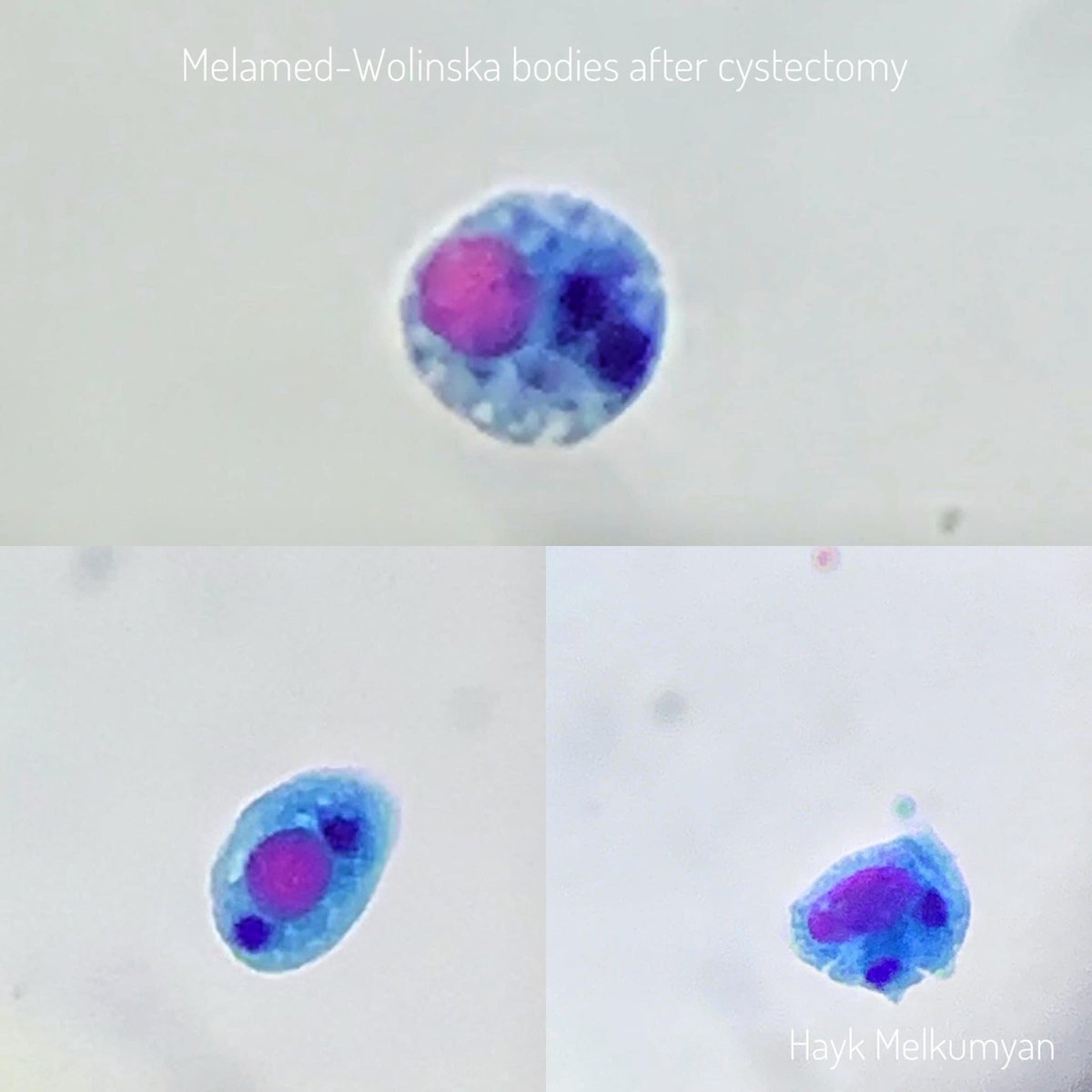 amigaRUTH's tweet photo. Del excelente citólogo @HaykMelkumyan! #Citology #Tweetpath #uropath #urocytology https://t.co/kjSDjhpQhK