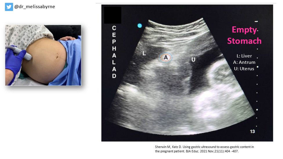 4/
How does #gastricultrasound differ in a pregnant patient?
#POCUS
1) Look deeper
2) Have the patient hold her breath
3) ID the uterus
4) Parasagittal approach