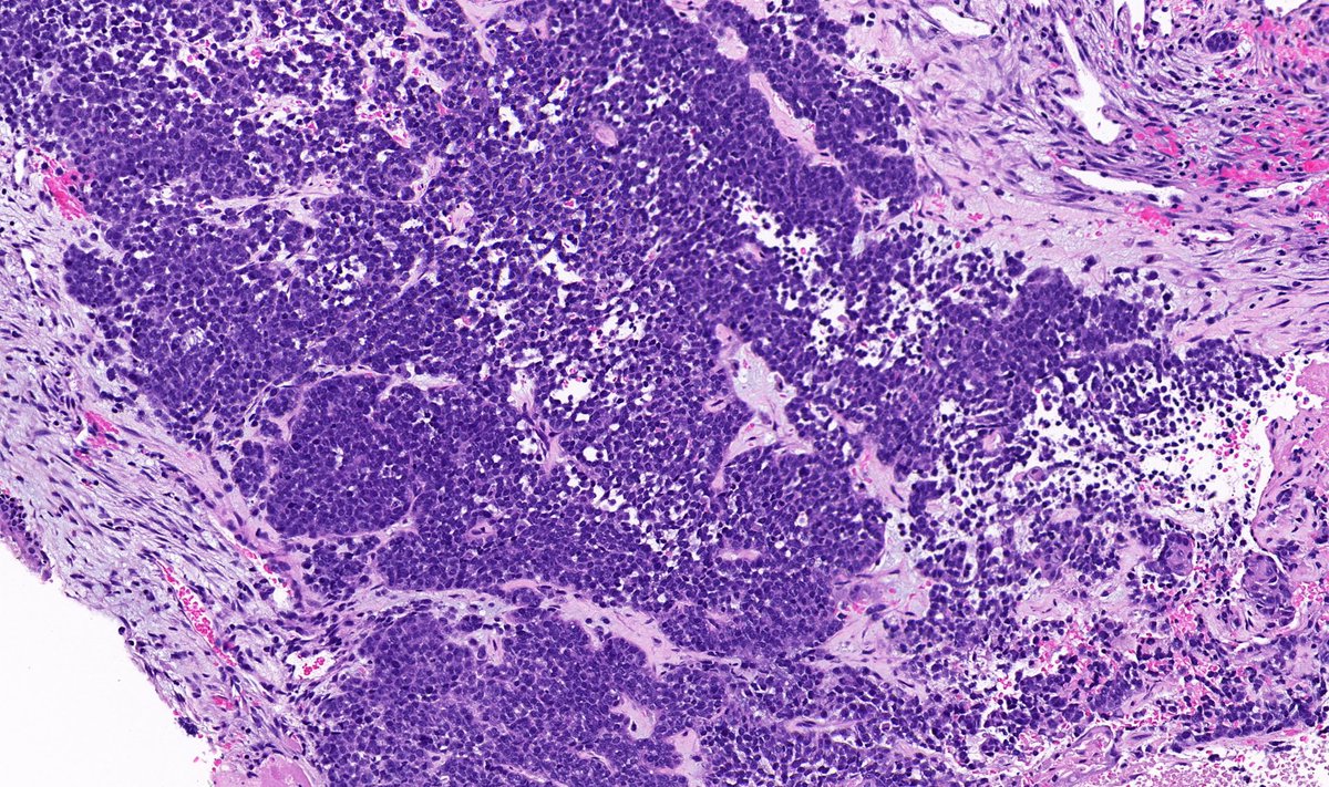 TristanRutland7's tweet photo. Head and neck tumour

#ENTpath #Oralpath #BSTpath #pathresidents #PathTwitter https://t.co/S6sr0OalCm