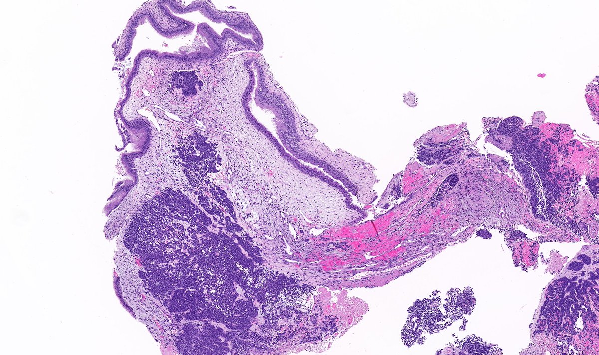 TristanRutland7's tweet photo. Head and neck tumour

#ENTpath #Oralpath #BSTpath #pathresidents #PathTwitter https://t.co/S6sr0OalCm