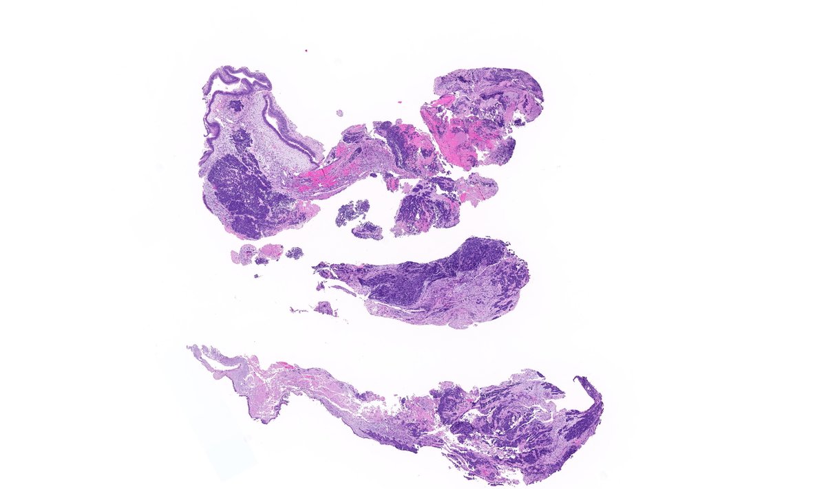 TristanRutland7's tweet photo. Head and neck tumour

#ENTpath #Oralpath #BSTpath #pathresidents #PathTwitter https://t.co/S6sr0OalCm