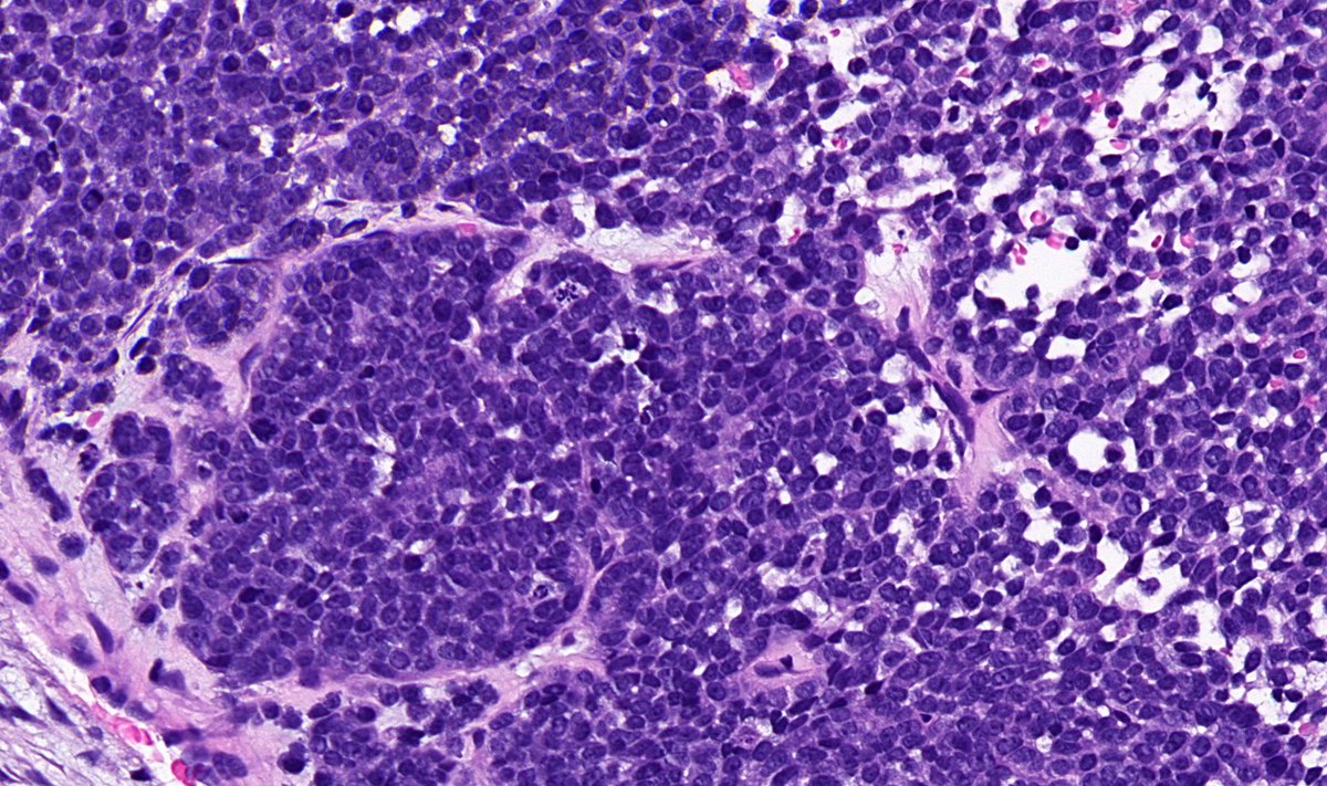 TristanRutland7's tweet photo. Head and neck tumour

#ENTpath #Oralpath #BSTpath #pathresidents #PathTwitter https://t.co/S6sr0OalCm