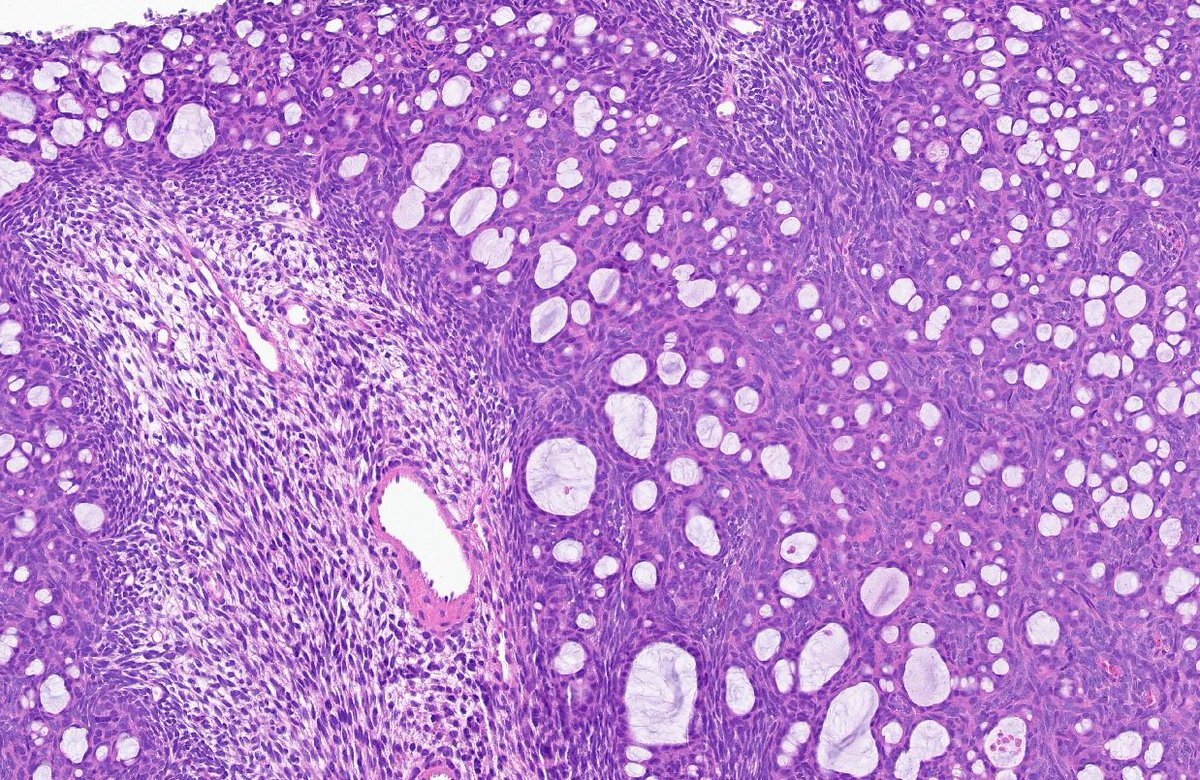👩🏻‍⚕️Thought the histology was beautiful and wanted to share. Picture perfect. 🖼 IHC for TLE and SS18-SSX both pos! #pathart #softtissue #butitcametoderm #pathology